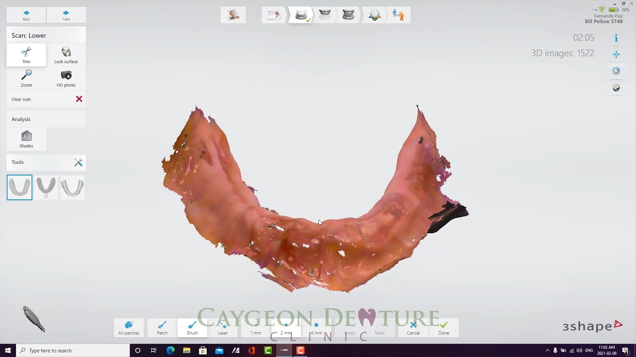 Scanning Workflow to Fabricate a Complete Lower Denture