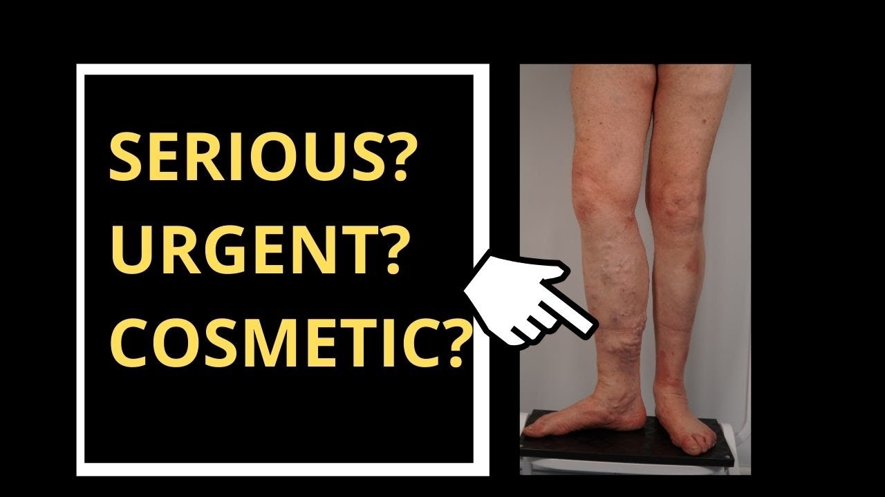 LEG VEINS: WHAT IS SERIOUS, WHAT IS URGENT, WHAT IS COSMETIC?