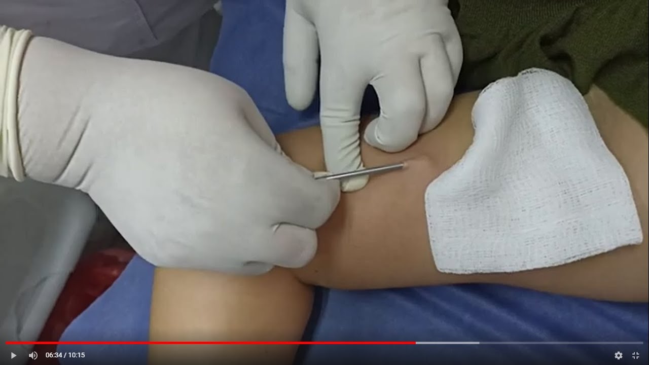 Inserción implante subdérmico