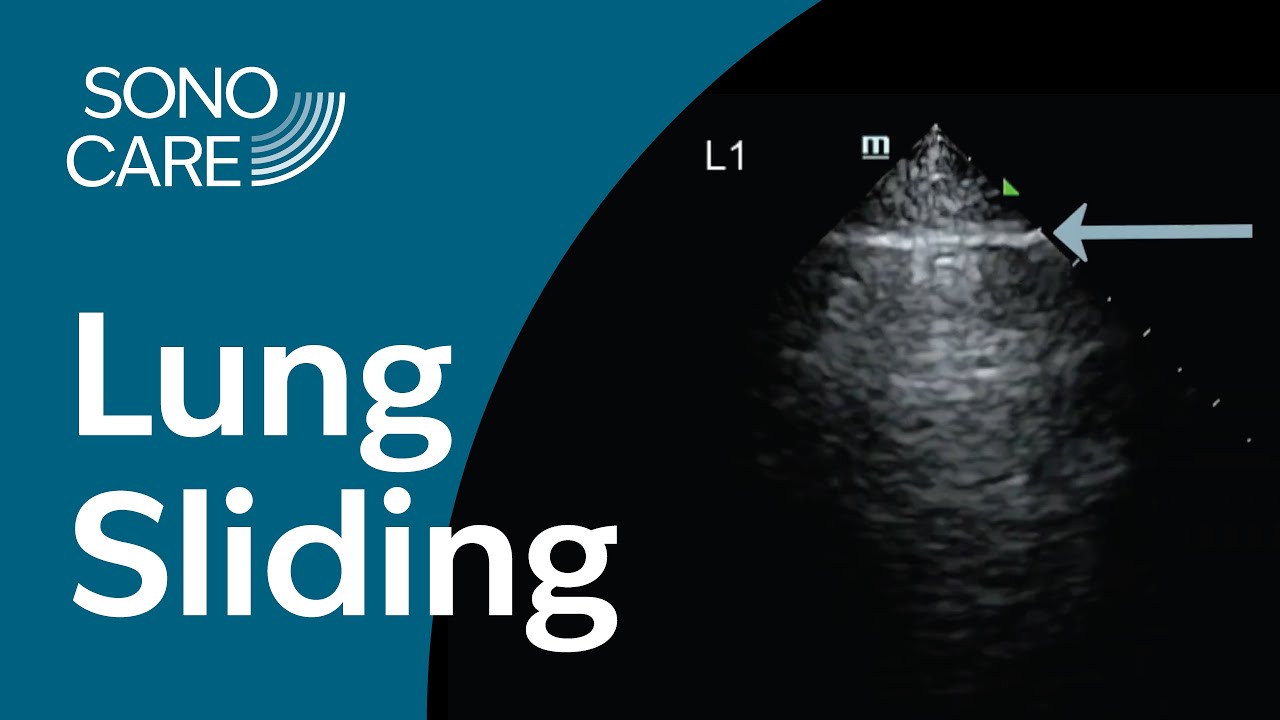 Lung Sliding: Lung #1
