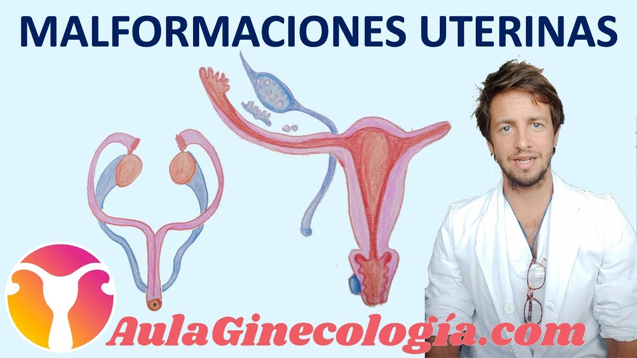 MALFORMACIONES UTERINAS: bicorne, septo, arcuato, didelfo, agenesias   - Ginecología y Obstetricia -