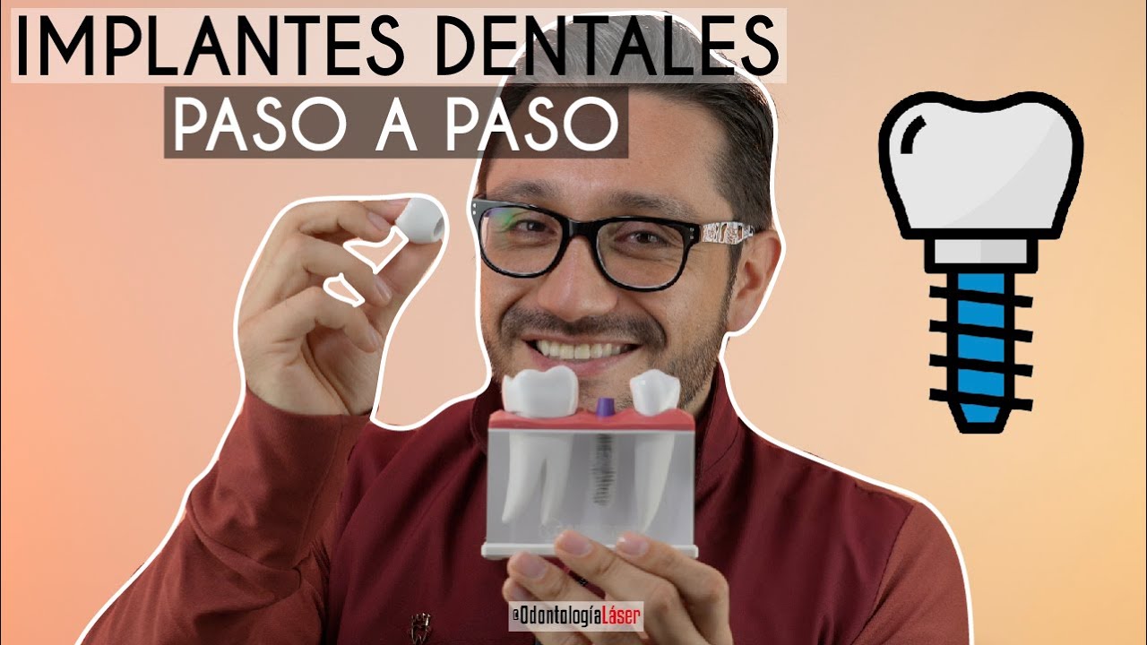 &iquest;C&oacute;mo se ponen los Implantes Dentales Paso a Paso? 🔩 &iquest;Duelen? - Odontolog&iacute;a L&aacute;ser.