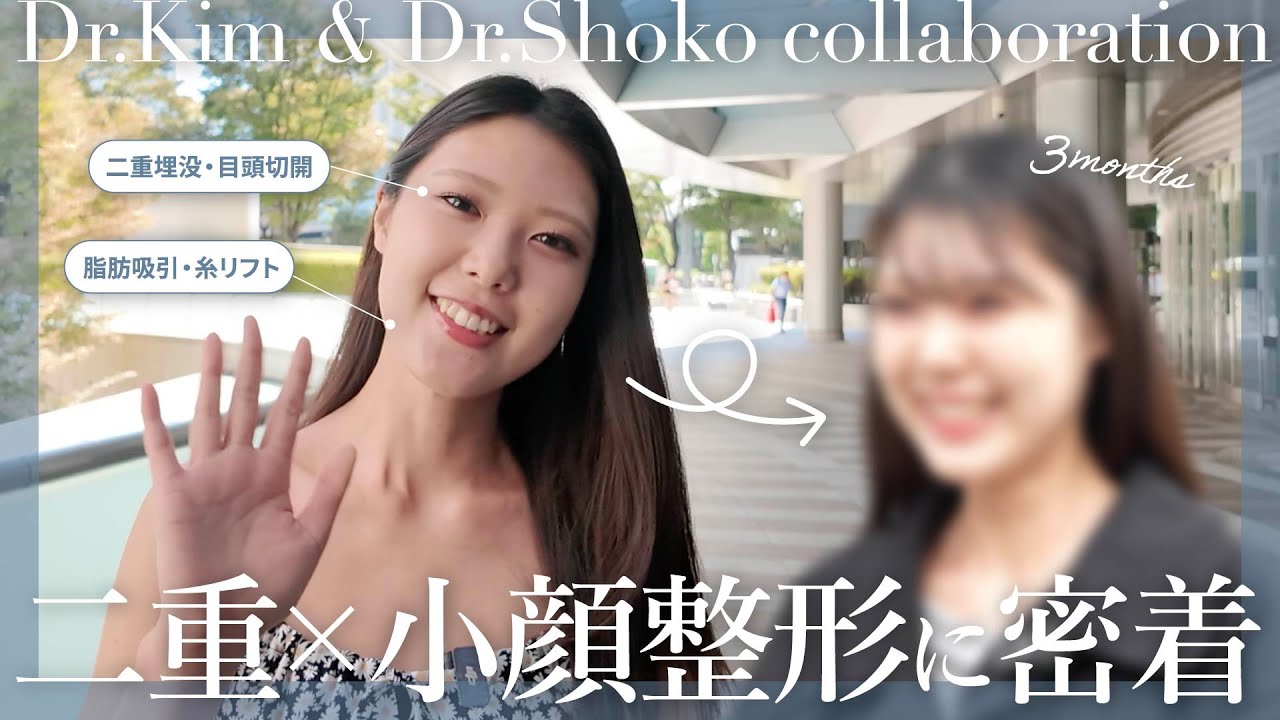 【小顔脂肪吸引】2回目の整形！金先生としょうこ先生で手術！SBCスタッフがダウンタイムまで完全レポ！【二重整形】