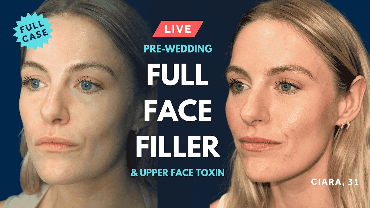 Ciara’s Pre-Wedding Aesthetic Treatments 💎 GEM© Case Study inc Botox, Tear Troughs & Midface Filler