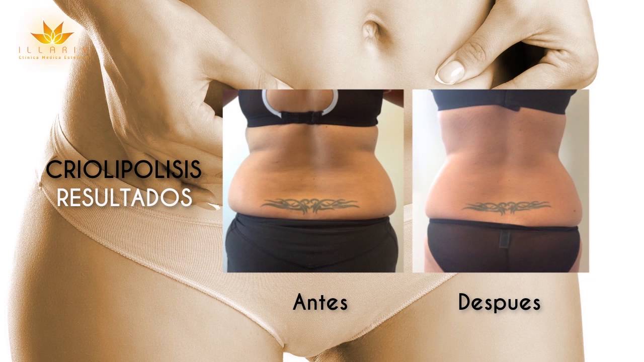 Que es la Criolipolisis