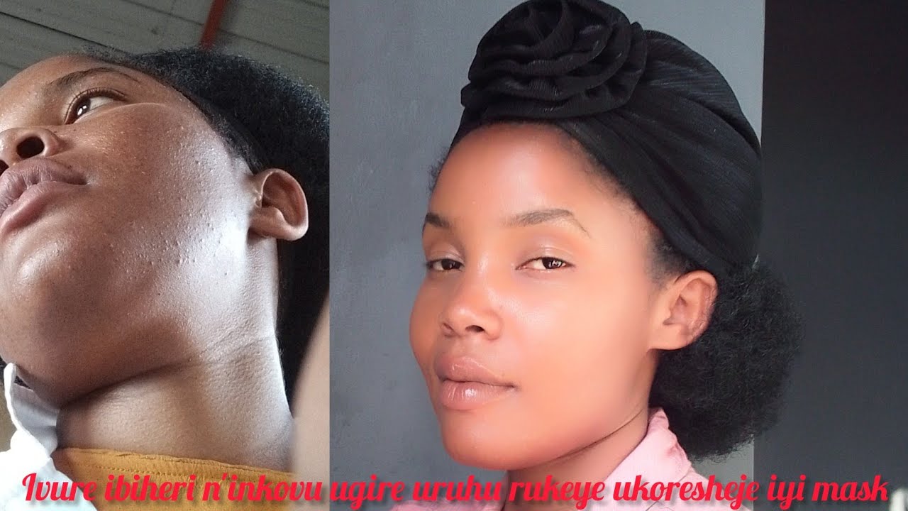 Ivure ibiheri n'inkovu ugire uruhu rukeye Kandi rufite itoto/ heal pimples/scars to clear your skin 