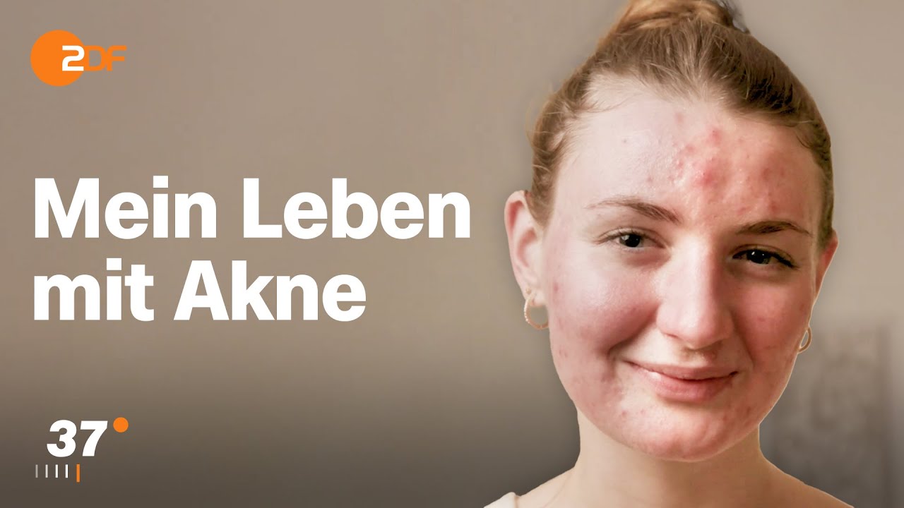 Mehr als nur Pickel: Wenn Akne das Leben bestimmt I 37 Grad