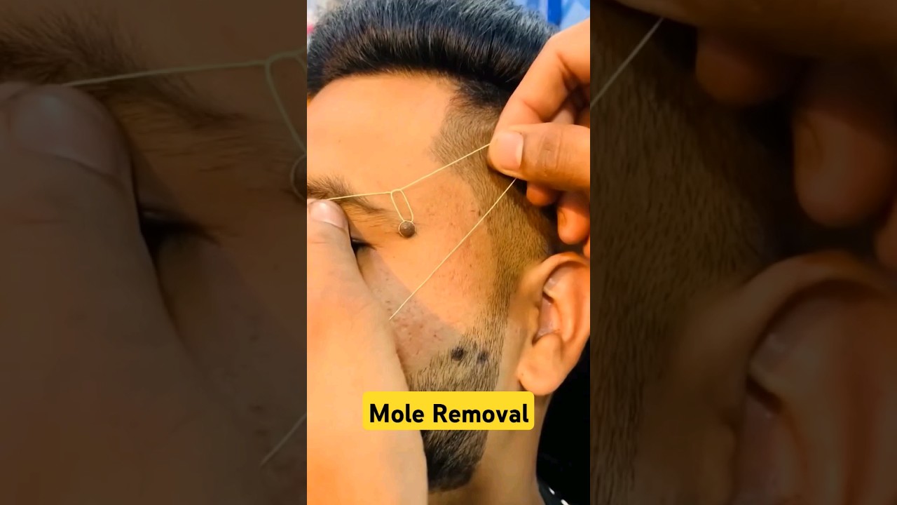 How to remove a mole? #moles #moleremoval #shorts #drniveditadadu