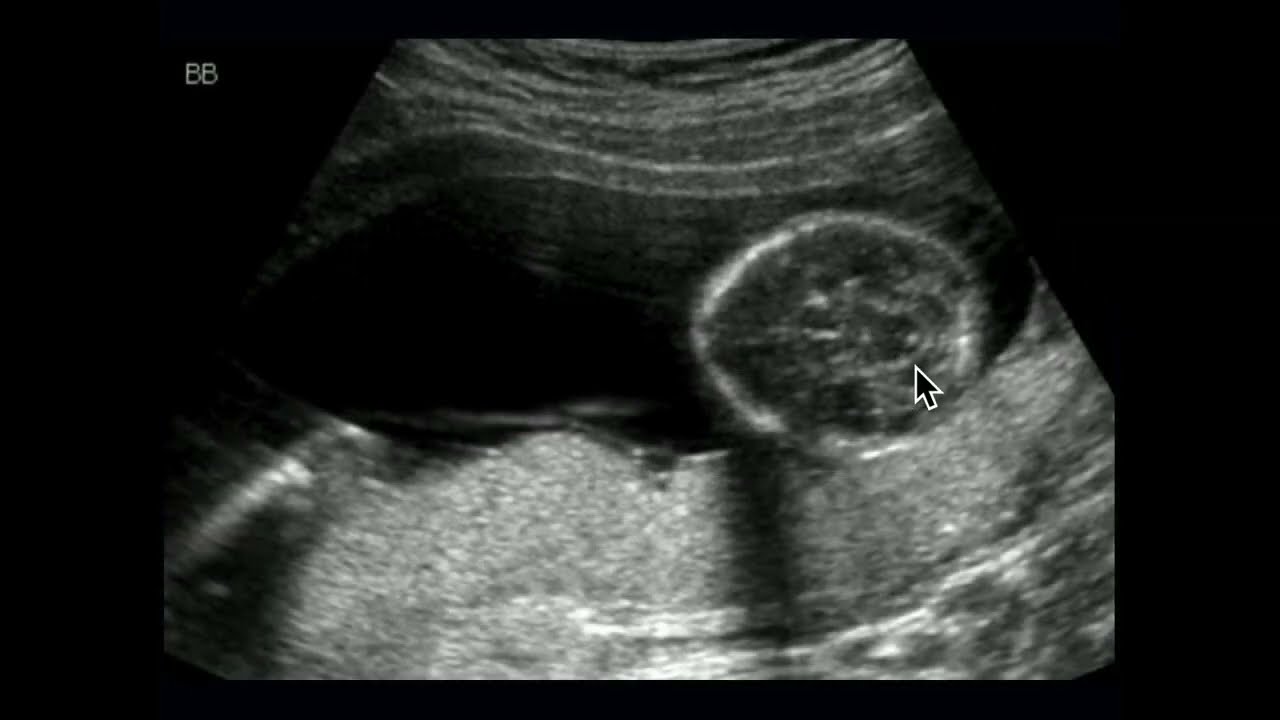 2022 Classic Lectures in Women&rsquo;s Imaging - A Video CME Teaching Activity