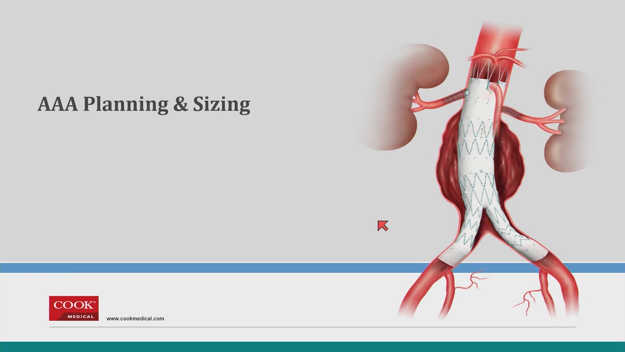 Planning and Sizing for AAA – How I Do It