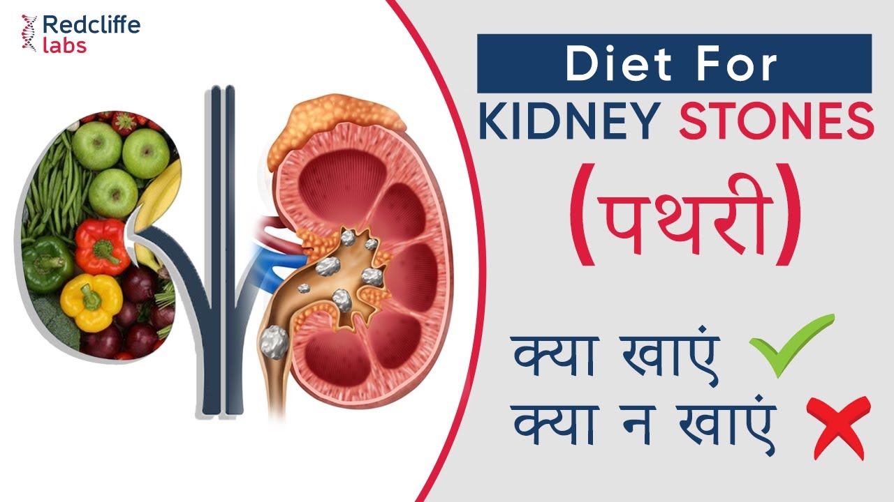 ✅ Diet for Kidney stones in Hindi | किडनी स्टोन में भूल से भी नहीं खाएं ये चीजें | Kidney Stone Diet