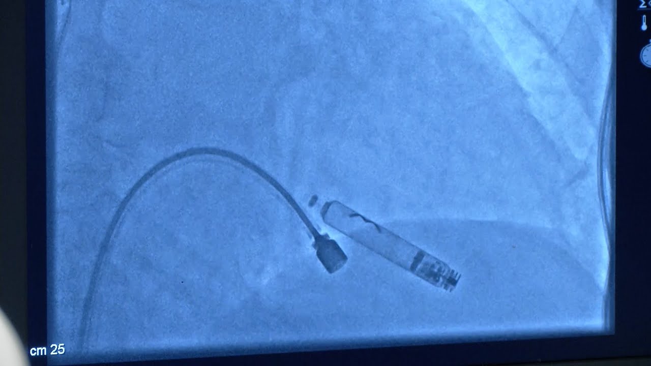 KU Hospital Implants Region's First Leadless Pacemaker