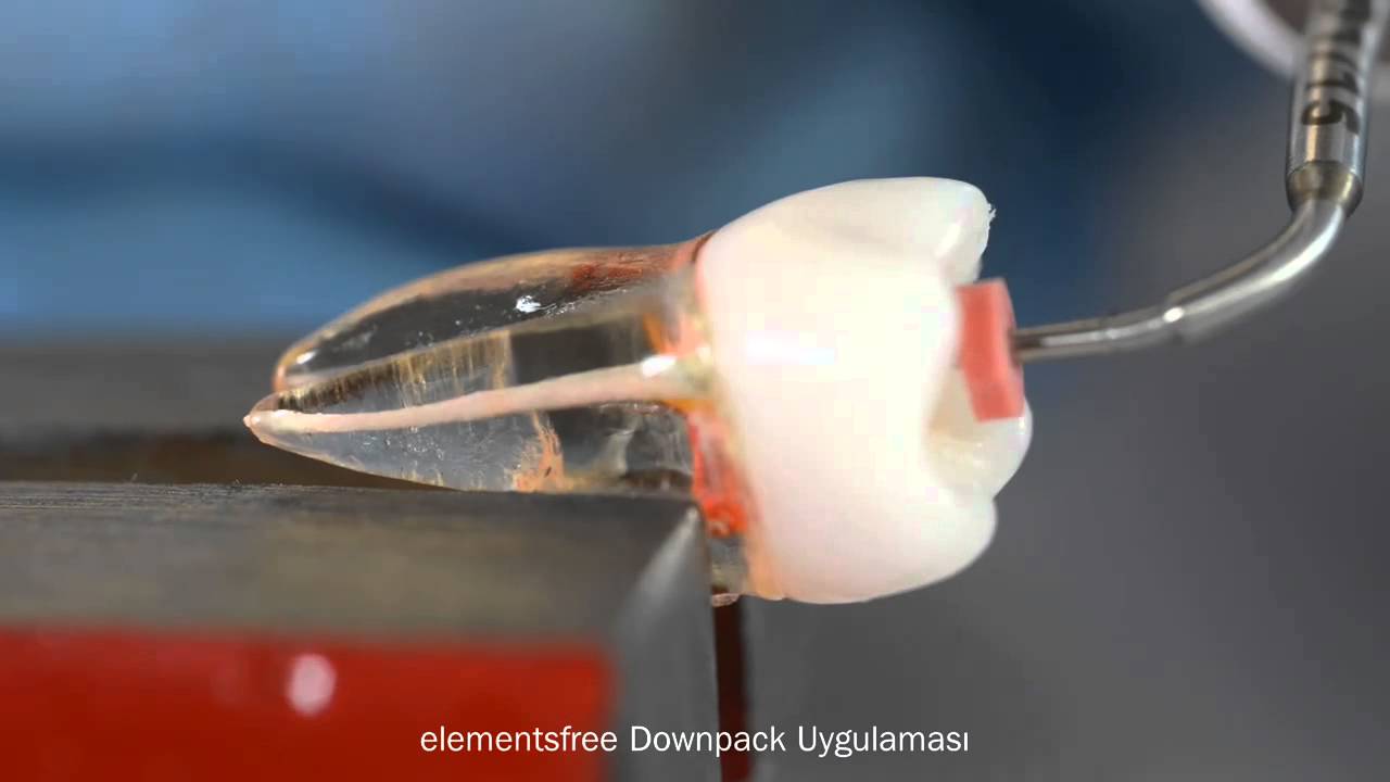 Kerr Endodontics ile Kök Kanal Obturasyonu