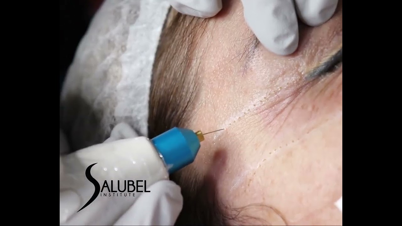 ✨ Lifting de P&aacute;rpados con Fibroblast ✨