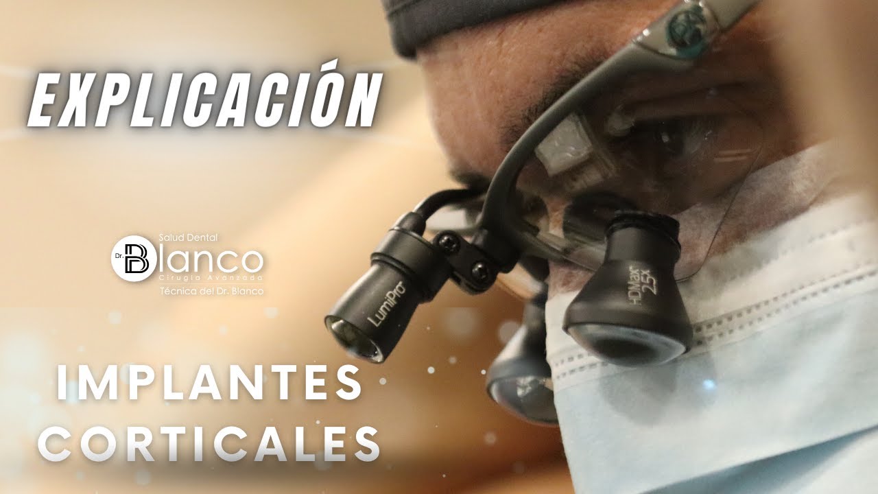 Implantes corticales en arcada superior. &iquest;En qu&eacute; consisten?