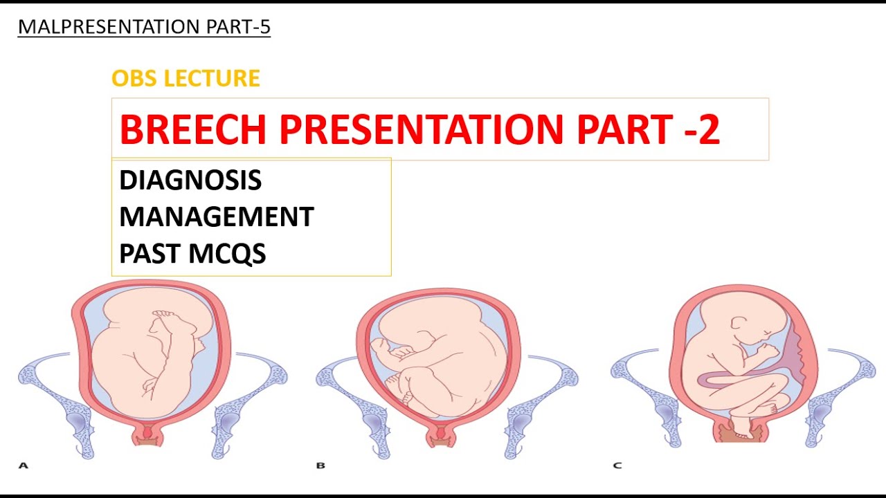 BREECH PRESENTATION PART-2| DIAGNOSIS | ECV | VAGINAL BREECH DELIVERY | MCQS| MALPRESENTATION PART 5