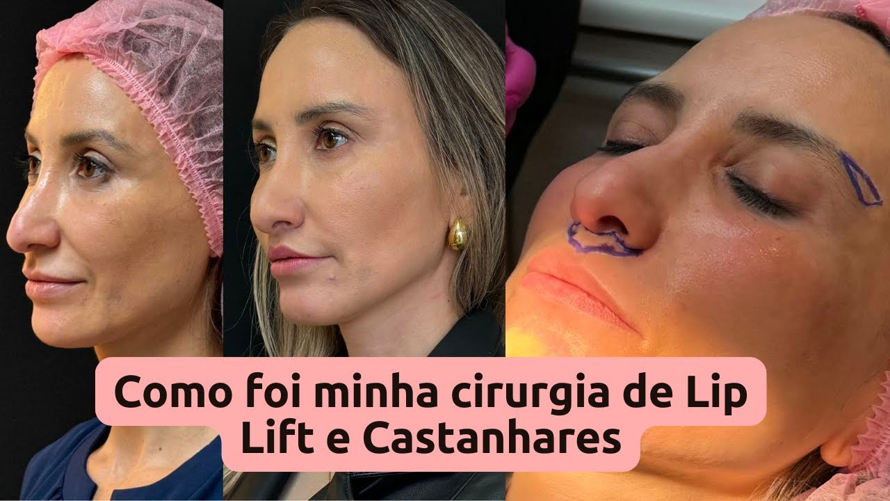 Meu liplift e castanhares