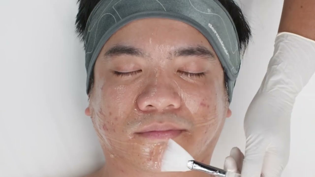 Salicylic Acid 15% Gel Peel