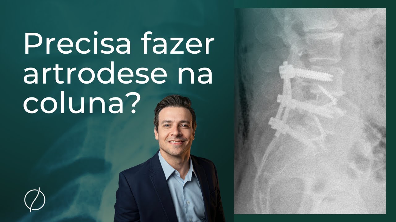 Precisa fazer artrodese na coluna?