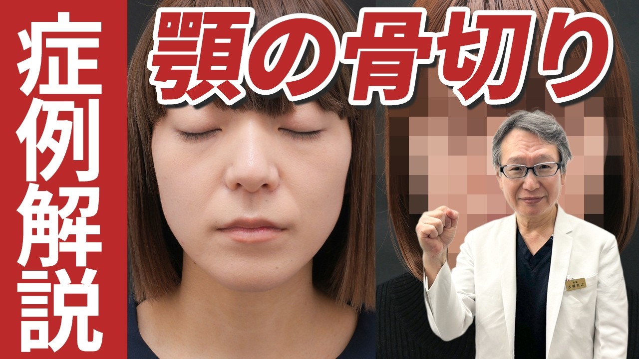 【症例解説】顎の骨切りとは？手術方法、ビフォーアフターまで解説