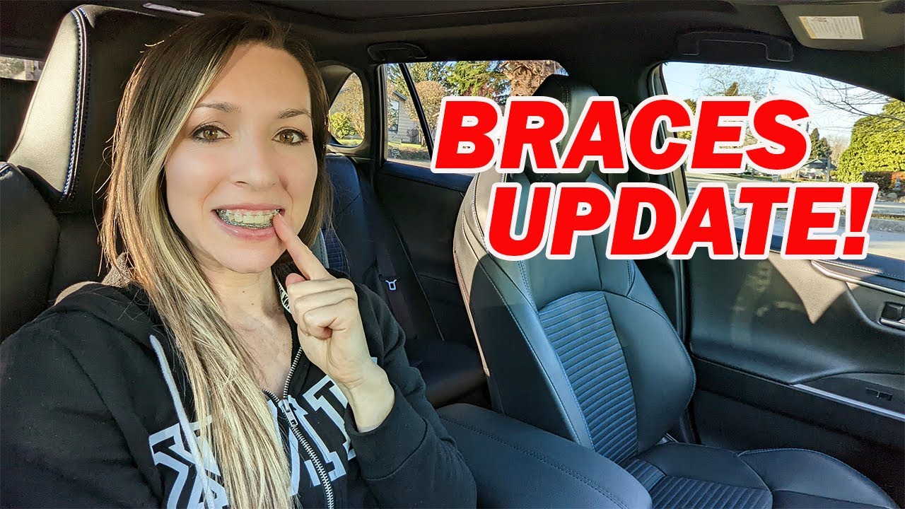 Adult BRACES Journey // 7 Month Update & Progress Pics