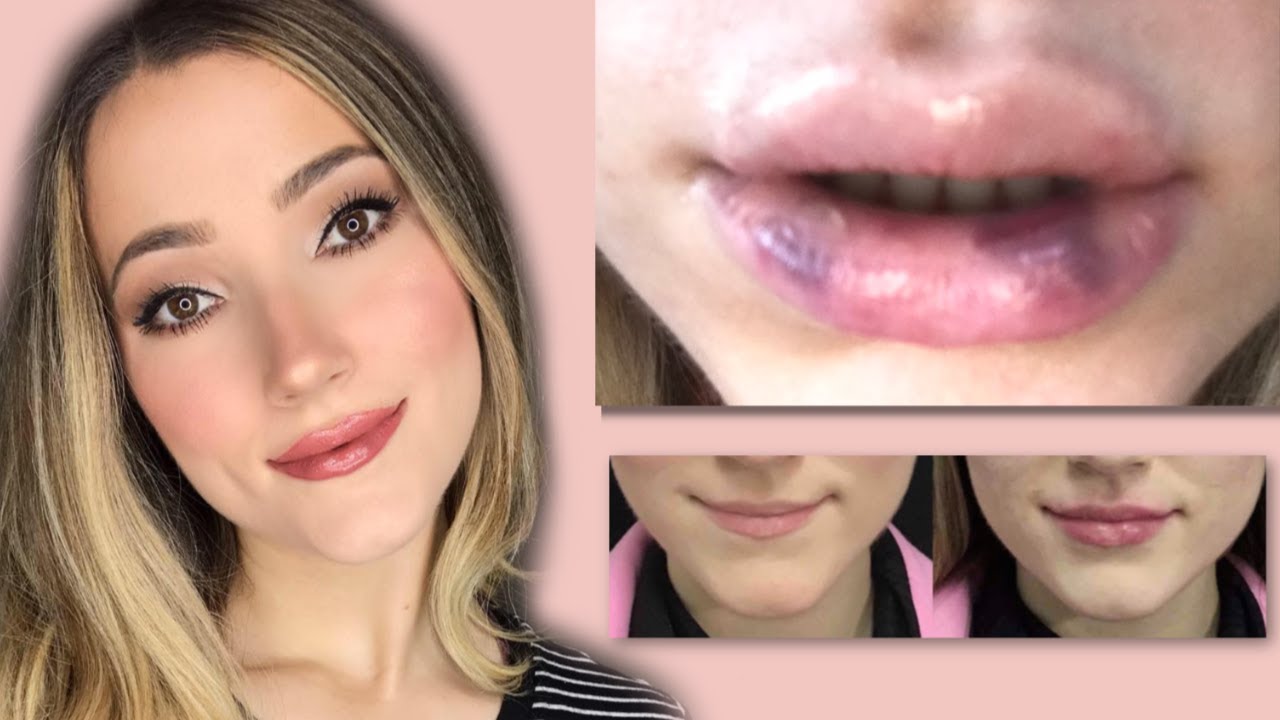 FIRST TIME LIP FILLER VLOG AND EXPERIENCE