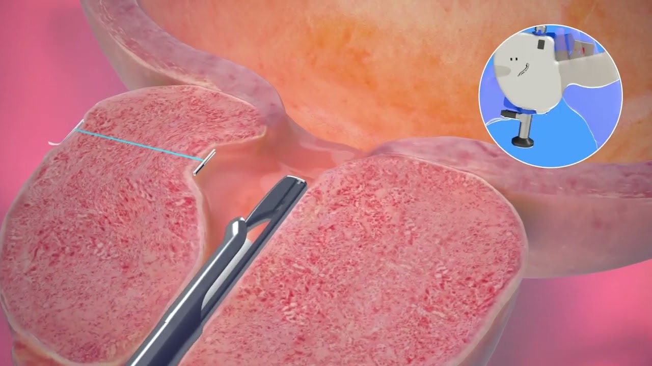 UroLift System Animation
