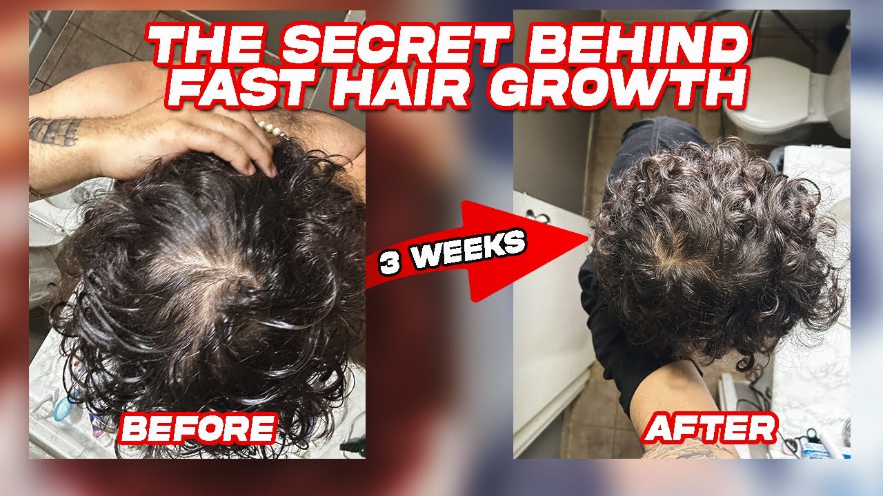 The Routine That Grew My Hair Back! | Essential Oils & Dermastamp