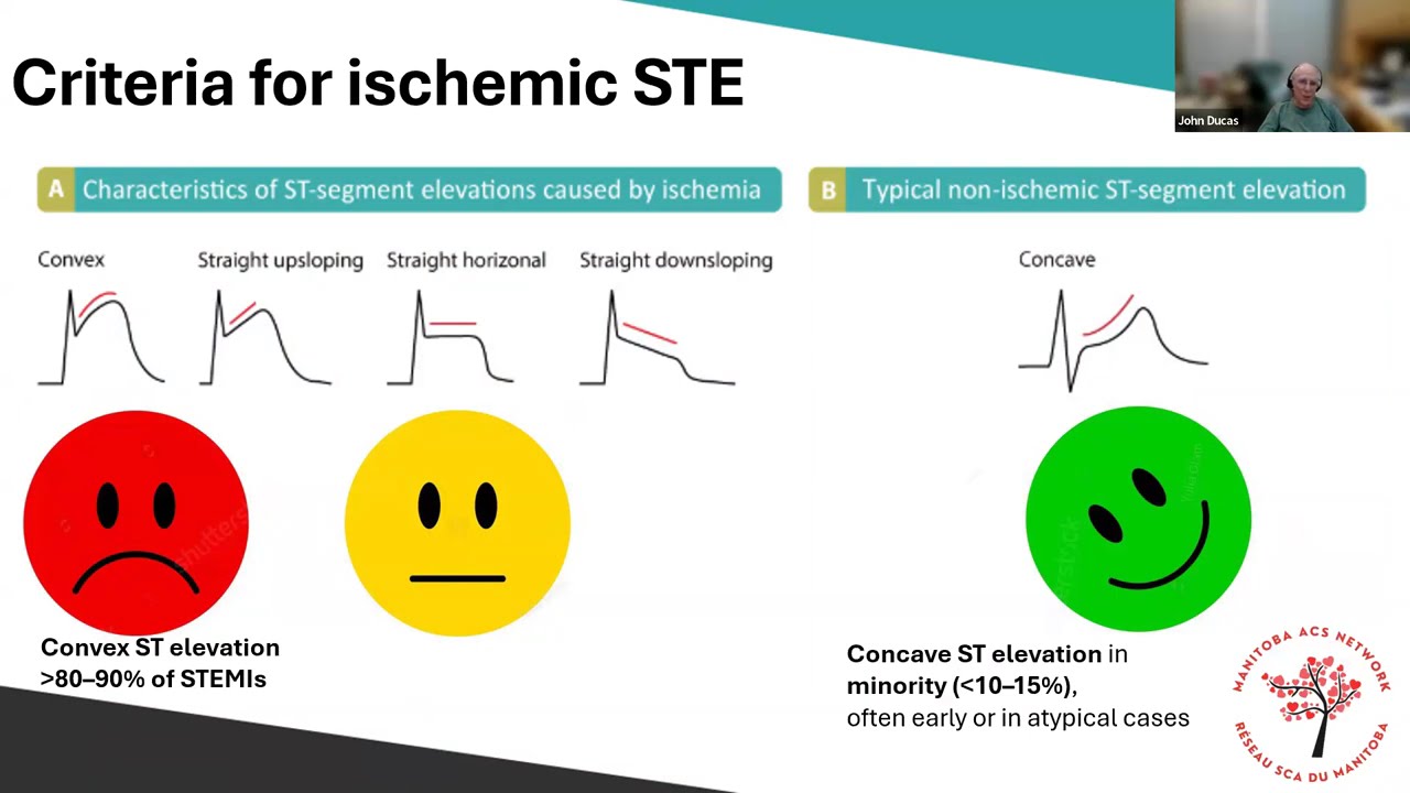 University of Manitoba OWN CME - ECG in ACS Session (16-04-2025)