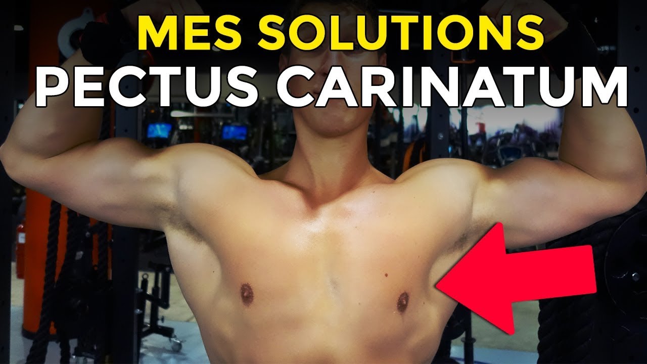 PECTUS CARINATUM OU THORAX BRECHET : LA SOLUTION EN MUSCULATION