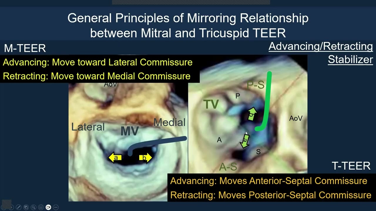 ACS2025 Lecture: Mirroring Mitral and Tricuspid TEER Procedures: Step by Step