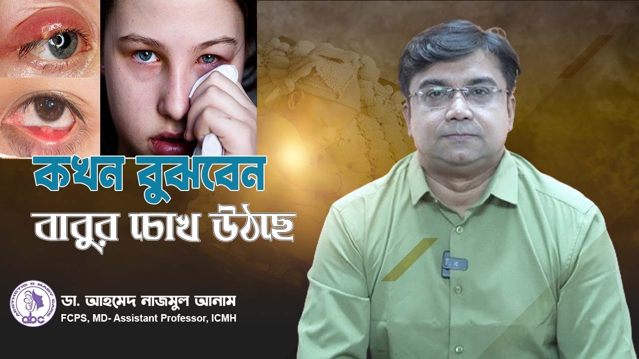 কখন বুঝবেন বাবুর চোখ উঠছে।। ডাঃ আহমেদ নাজমুল আনাম || FCPS, MD- Assistant Professor, ICMH