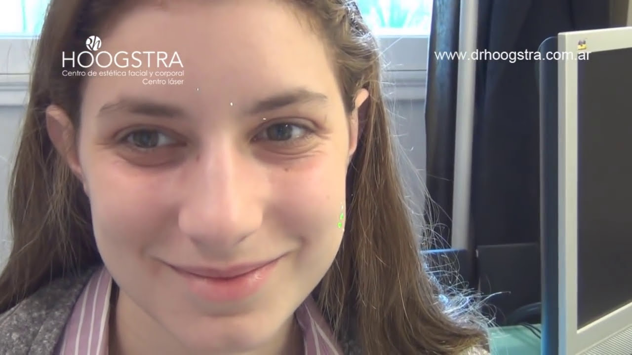 ¿Cómo eliminar las Ojeras? Tratamiento Láser con Co2 (13002)