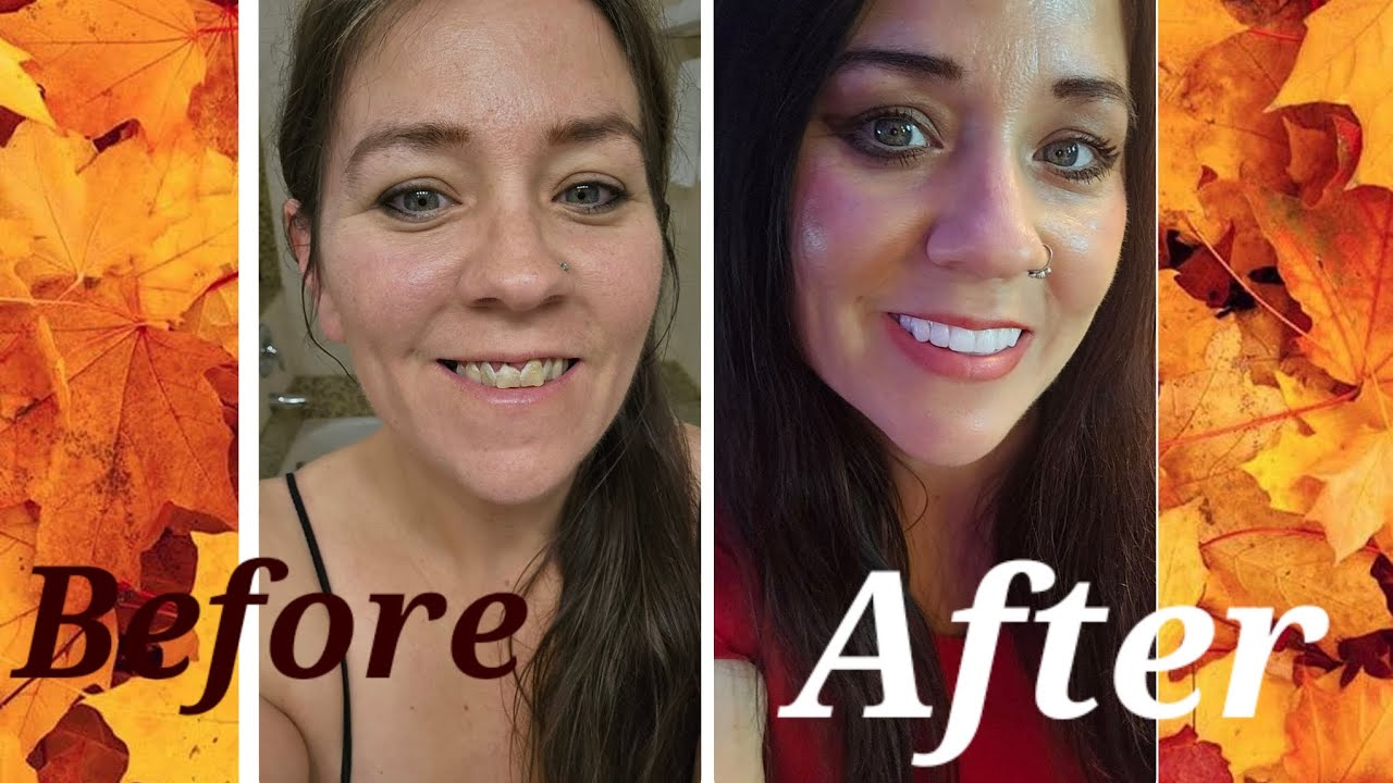 BEFORE AND AFTER MY ALL ON 4 SURGERY (An updated version) How far I've come and where I am now