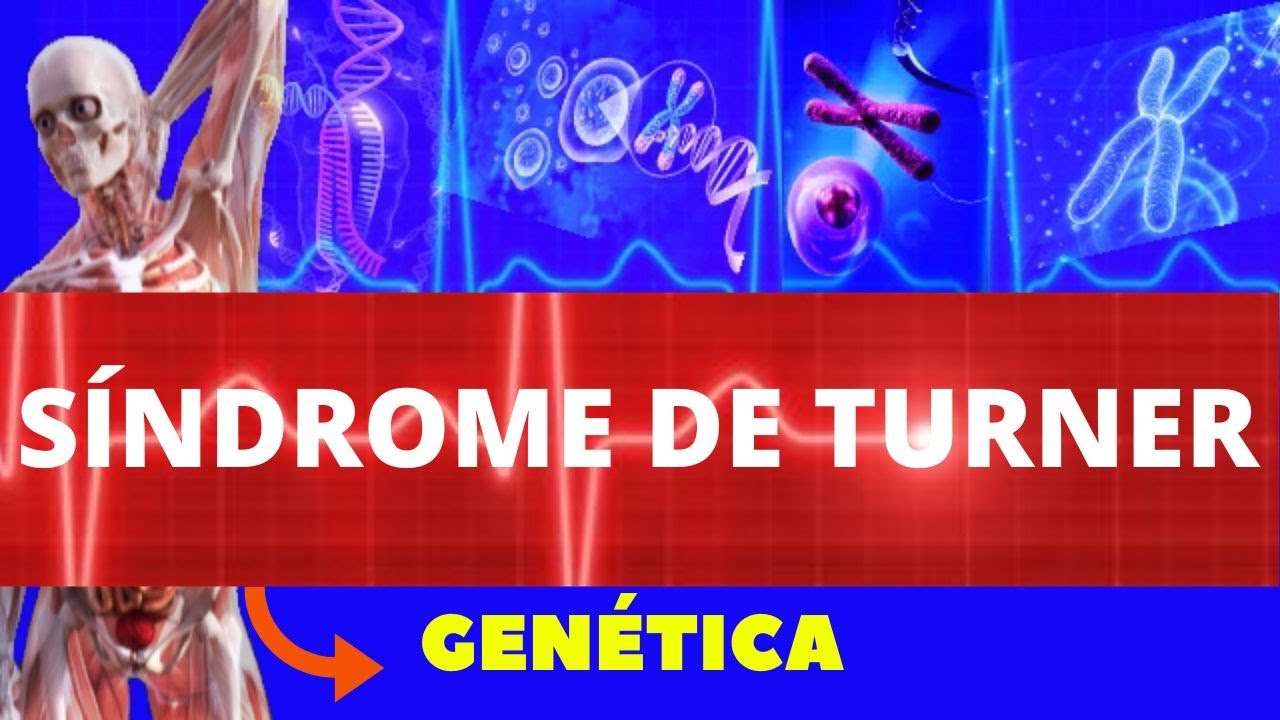 SÍNDROME DE TURNER - (O QUE É, CAUSAS, CARACTERÍSTICAS, DIAGNOSTICO E TRATAMENTO) CARIÓTIPO GENÉTICA