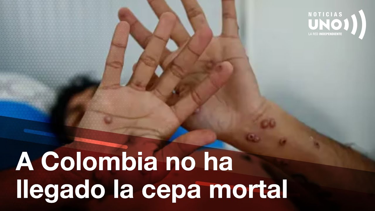 Colombia es el segundo pa&iacute;s con m&aacute;s casos del virus mpox en Latinoam&eacute;rica | Noticias UNO