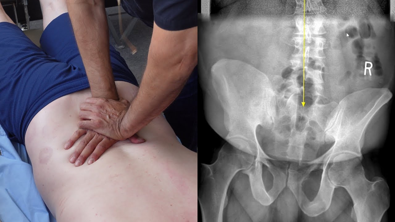 Back Pain from Severely Titled Pelvis & Fusing Foundation HELPED! Dr. Rahim