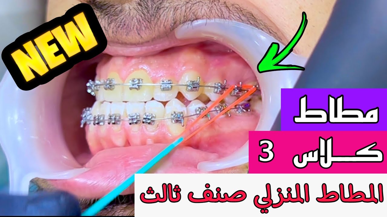 تقويم الدايمون مع مطاط صنف ثالث | طريقه استخدام المطاط المنزلي ✅ Damon Braces & Class 3 elastics