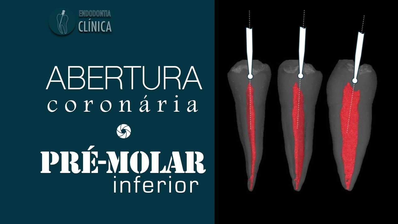 Anatomia e abertura coronária do Pré-Molar Inferior