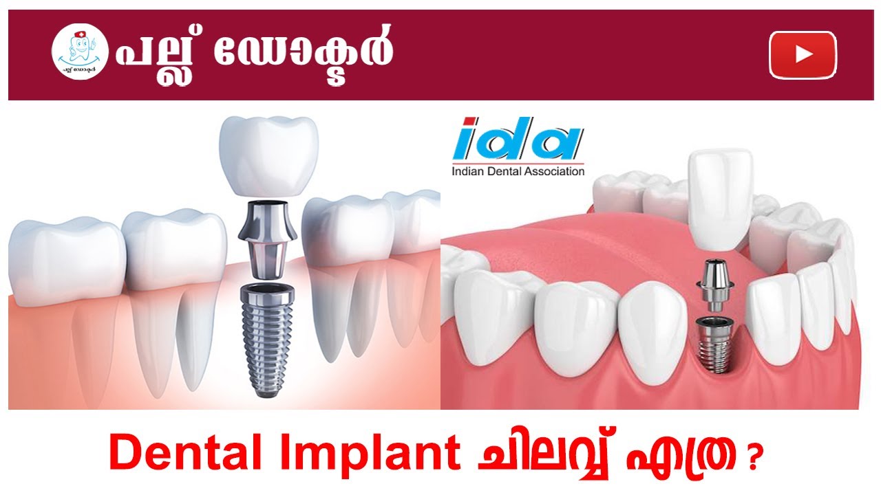 Dental Implant ചിലവ് എത്ര? l 
