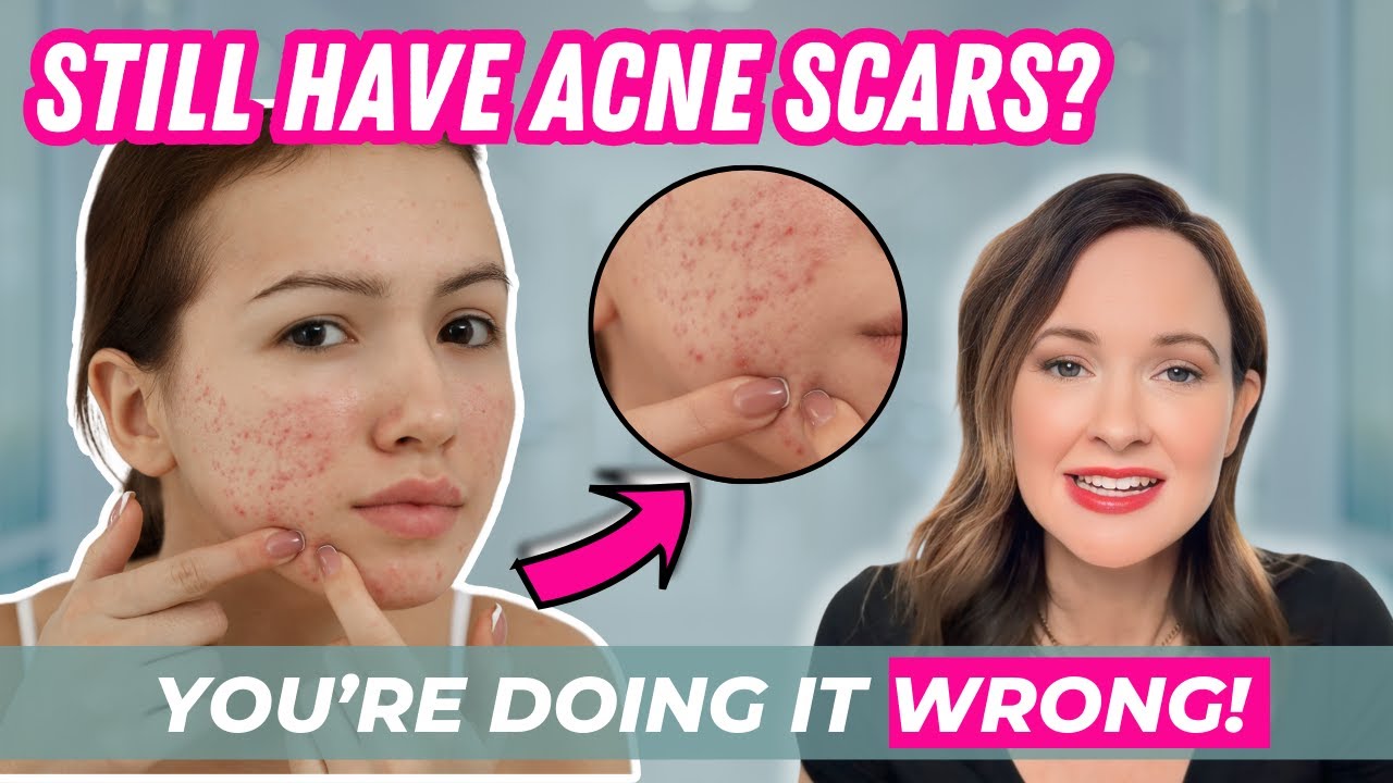 Best Treatments for Acne and Acne Scars