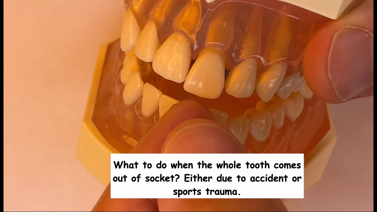 What to do when the whole tooth comes out of its socket? Avulsion - Dental emergency.