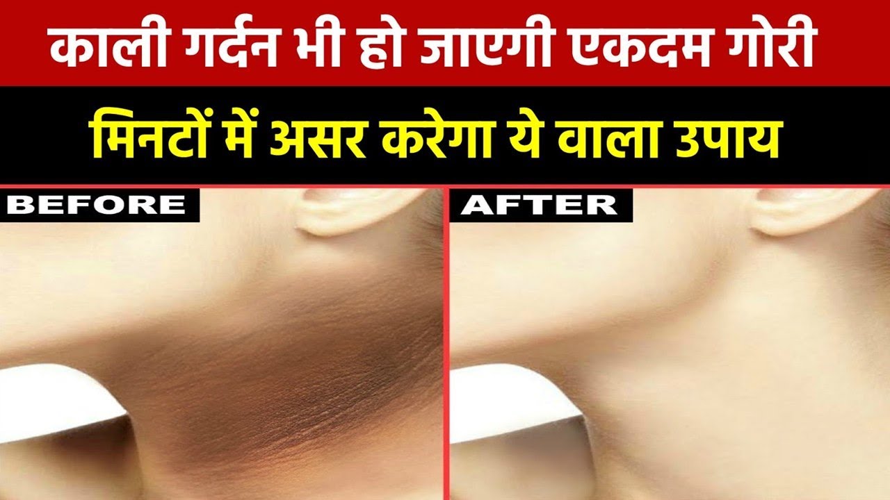 मिनटों में काली गर्दन भी हो जाएगी गोरी, ये वाला उपाय करके तो देखिए | Kali Gardan ko Gora Kaise Karen