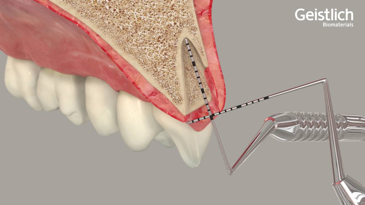 Geistlich Bio-Gide® Shape - Ridge Preservation (Geistlich Biomaterials)