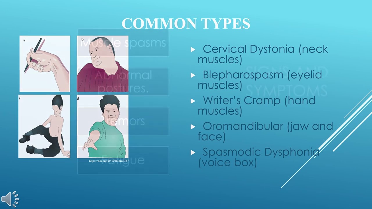 Understanding Dystonia A Neurological Movement Disorder