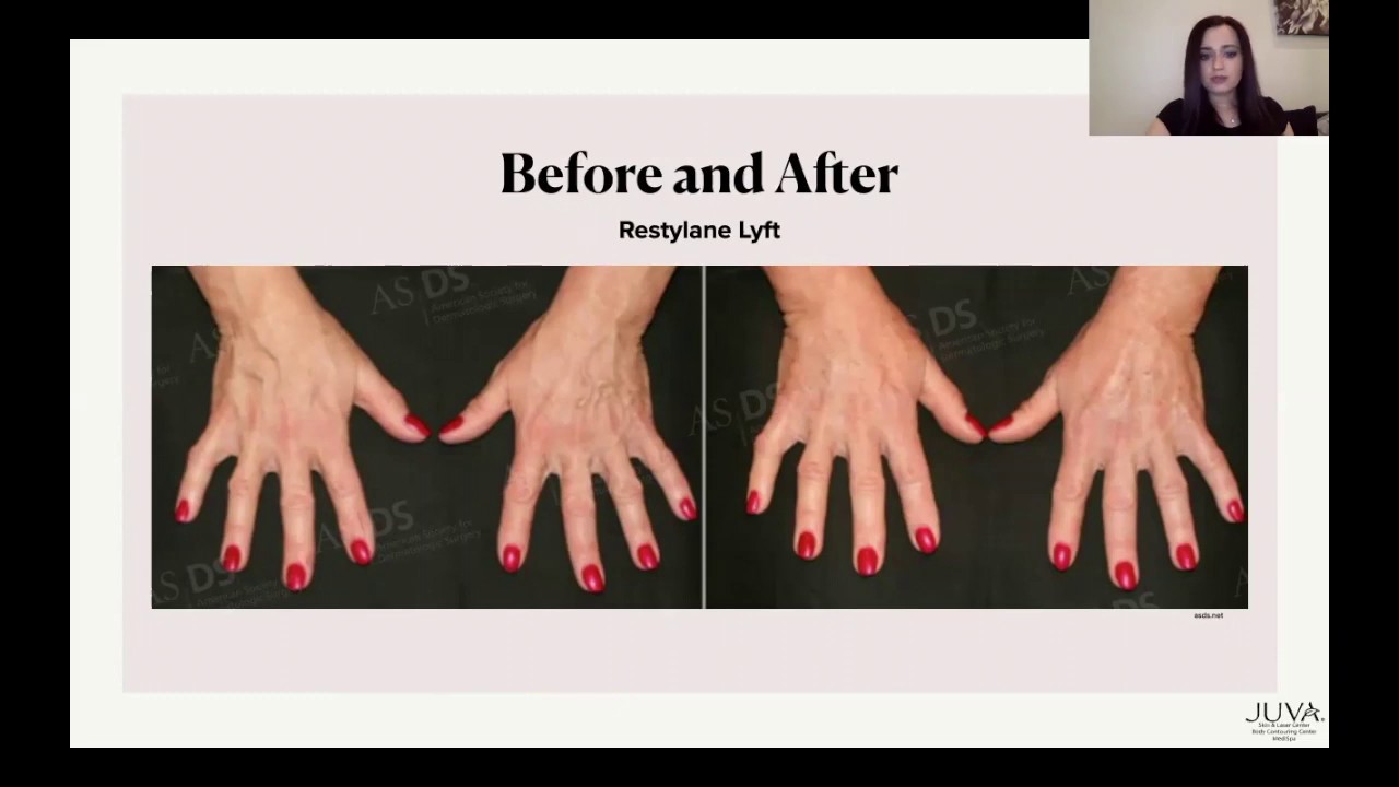 Learn About Amazing Hand Rejuvenation Techniques