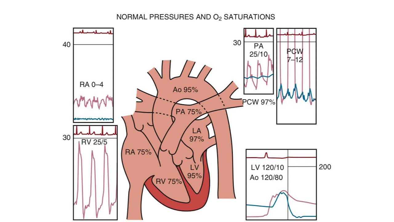 Right Heart Catheterization  - an introduction