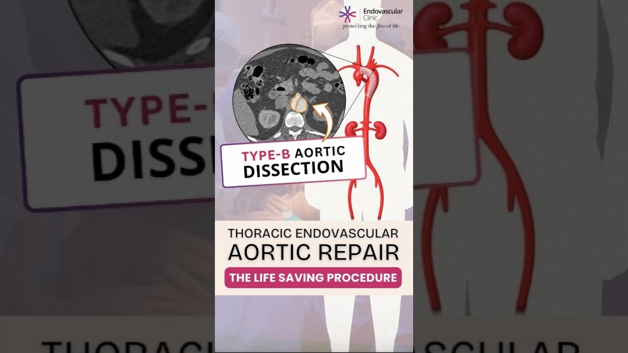 Thoracic Endovascular Repair (TEVAR) for Aortic Dissection | Minimally Invasive Treatment