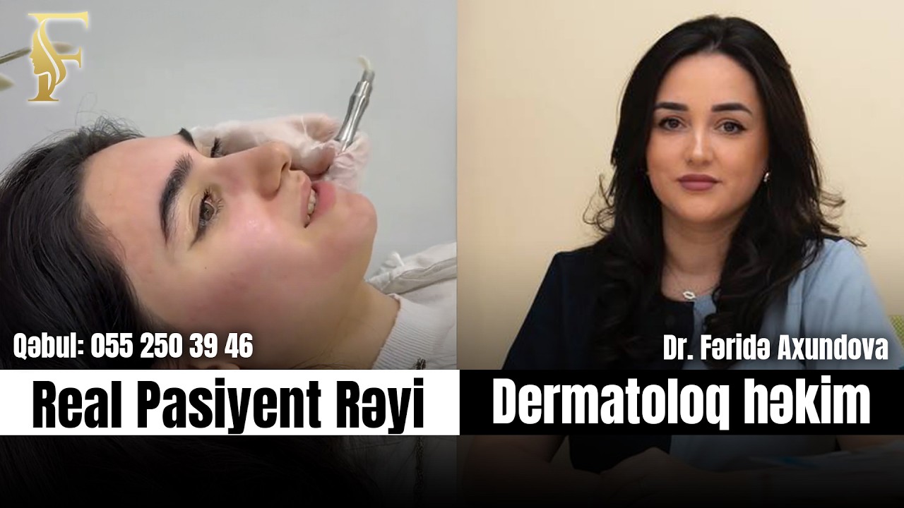 Uzunmüddətli Effekt: Akne Sonrası Həyat