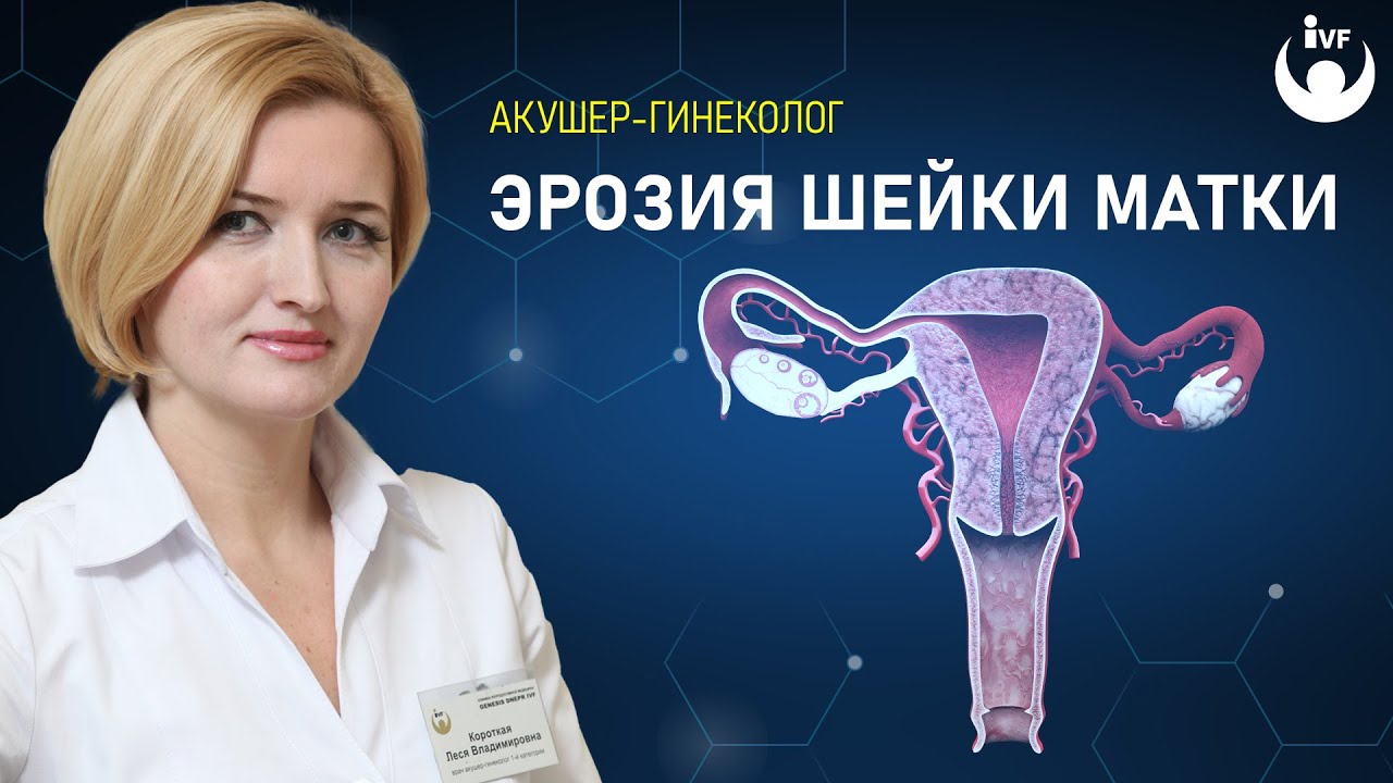 Эрозия шейки матки - лечить или не лечить, симптомы, причины. Гинекология в Генезис Днепр